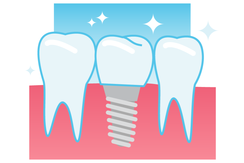 Dental implants illustration